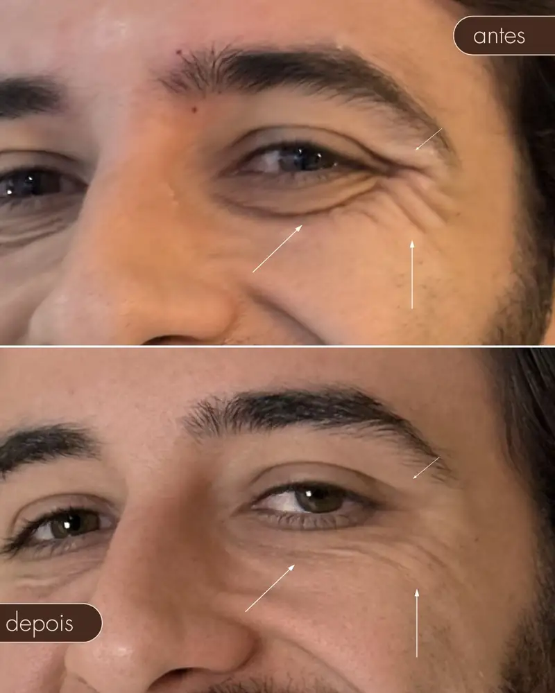 Antes e depois — Botox
